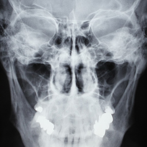 Radiografía de Senos paranasales (1 proyección)